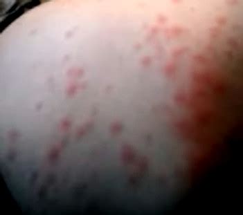 Amoxicillin Rash - Pictures, Treatment, Symptoms, Causes | Health Momma