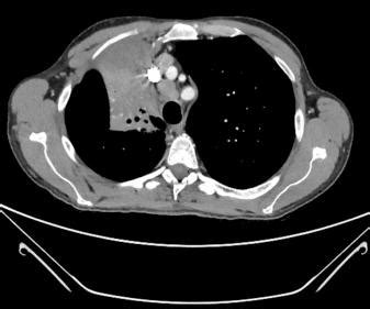 Anaesthesia For Thoracic Surgery Clinical Tree