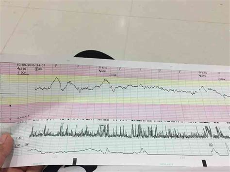 速看速学医护教你胎心监护怎么做才顺利通过 孕小帮