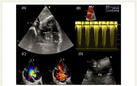 Pulmonary Valve Endocarditis In A Patient With Complex Cardiac Download Scientific Diagram