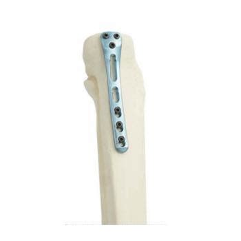 Trauma Lower Limb Orthopedic Titanium Alloy Proximal Posterior Medial