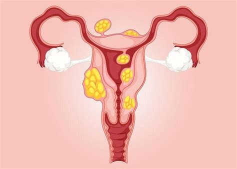 Uterine Fibroid Symptoms Causes And Treatment Fastlyheal