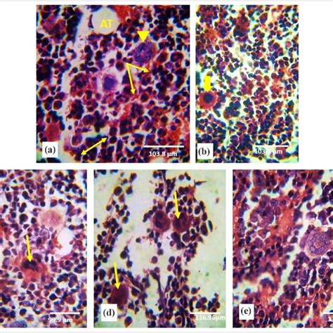 Photomicrograph Of Bone Marrow Biopsy Stained With H E A And B