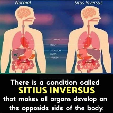 What is Situs Inversus? – CuriosityNew