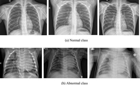 Sample Images From Chest X Ray Dataset A Normal Class B Abnormal Class Download Scientific