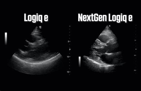 GE NextGen Logiq E Probo Medical