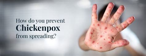 How Does Chickenpox Spread