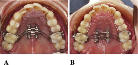 The Intraoral Photos In The Process Of Marpe A Initiation Of Marpe