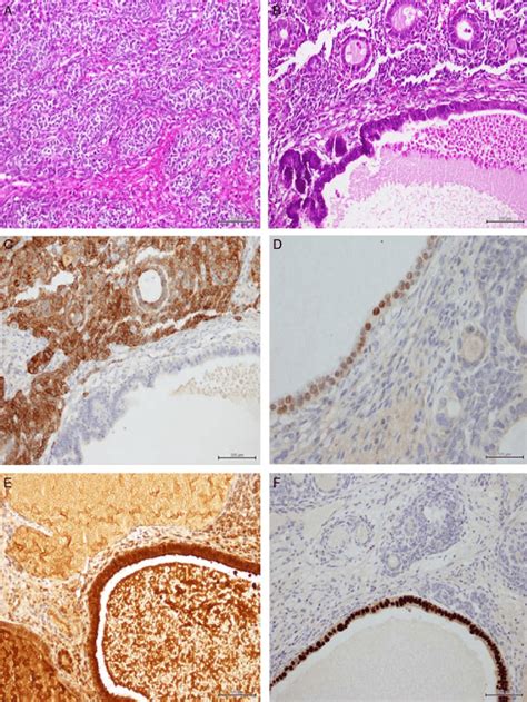 Case 1 Showing Sertoli Cells Arranged In Nests A Heterologous