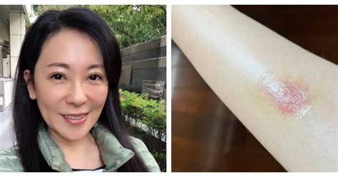 況明潔腳腫成包子！她被蚊子叮沒管 醫驚呼：險釀蜂窩性組織炎 娛樂 Ctwant