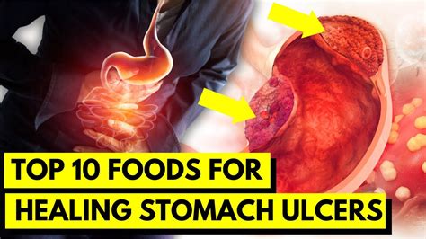 Top 10 Foods To Heal Your Stomach Ulcer Naturally Natural Remedies For Peptic Ulcers Youtube