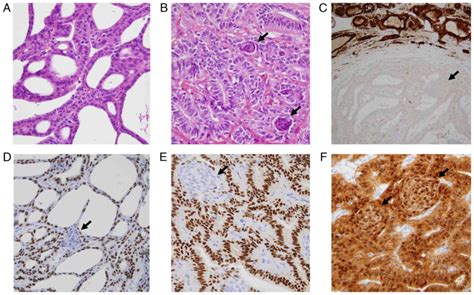 Cribriform Morular Thyroid Carcinoma Clinicopathological And Molecular