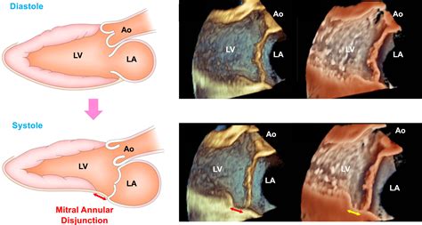 Mitral Annular DisjunctionA New Disease Spectrum Cardiology Clinics