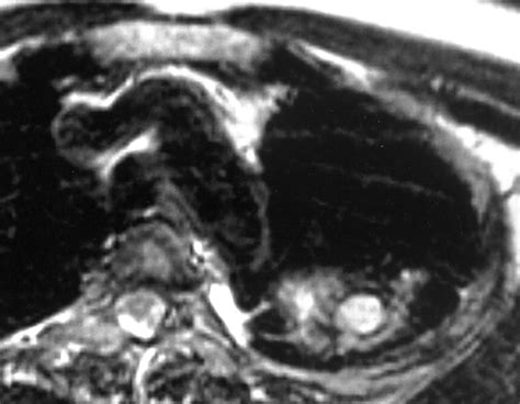 Intrapulmonary Bronchogenic Cyst Ct And Pathologic Findings In Five