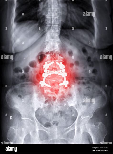 Imagen radiográfica de la columna lumbar que muestra cirugía de