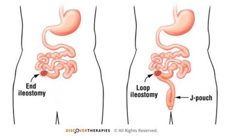 What Is A Stoma Part Ii Why And How