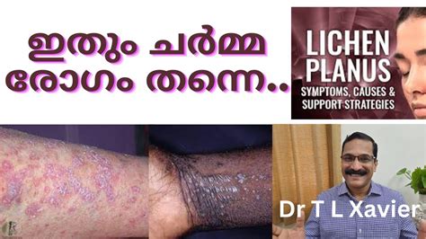 Lichen Planus Ayurvedic Solutions Dr T L Xavier Youtube