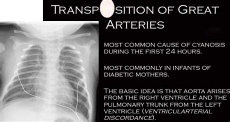 Cardiac Flashcards Quizlet