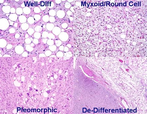 Liposarcoma Who Classification