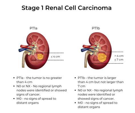 Kidney Cancer Stages | KCCure | kidney cancer | diagnosis | stages