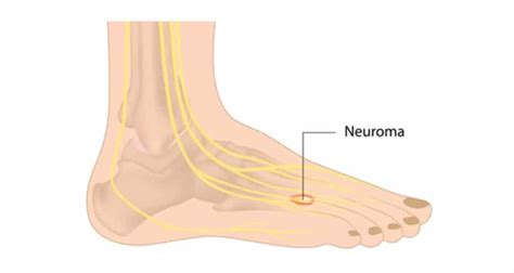 5 Causes for Numb Feet or Toes : r/FeetFirstClinic