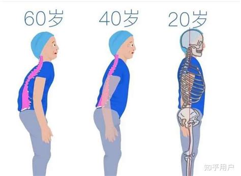 走路弯腰驼背怎么办？平时不管什么时候都要挺直腰板 知乎