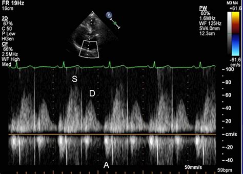 Transthoracic Echo Cardiac Sonography Medical Pictures Echo