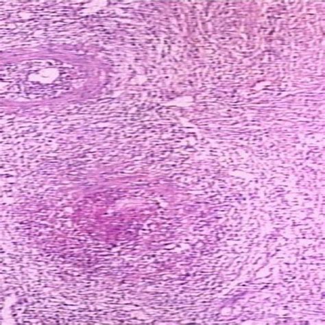 Necrotizing vasculitis compatible with PAN | Download Scientific Diagram