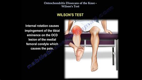 Knee Osteochondritis Dissecans Wilson S Test Everything You Need To Know Dr Nabil