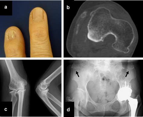 Total Knee Arthroplasty Without Reduction Of The Patella For Genu