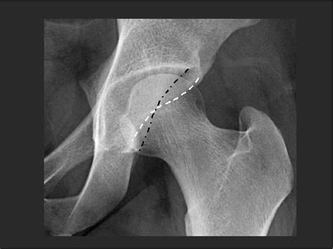 Figure From Diagn Stico Del Atrapamiento Femoroacetabular Mediante