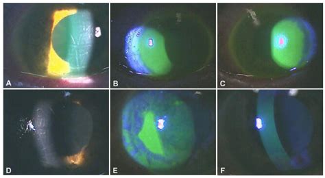 Progression Of Christmas Eye Disease Ulcer In The Right Eye A