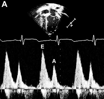 Pedi Cardiology Echo Mitral Inflow Doppler