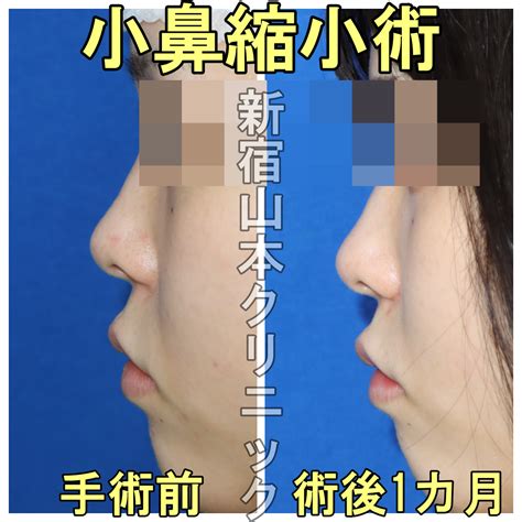 左右差のある鼻の穴も改善 やまくり女子すたっふの美的日常