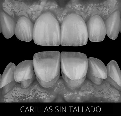 C Mo Se Colocan Las Carillas Dentales Institut Joan Autr N