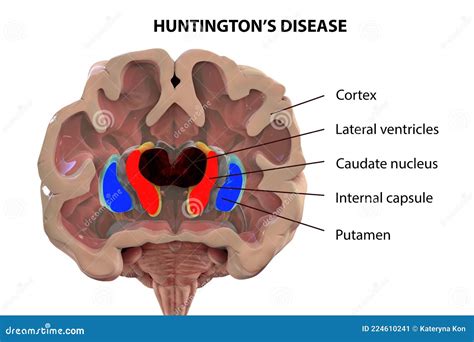 Coronal Section of a Brain of a Person with Huntington`s Disease Stock ...