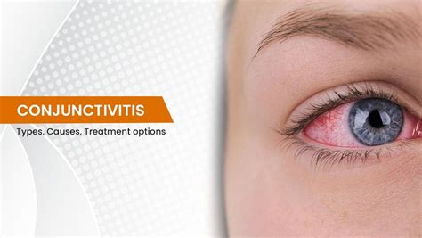 Conjunctivitis Types Causes Treatment Options Tambaram Medical Center