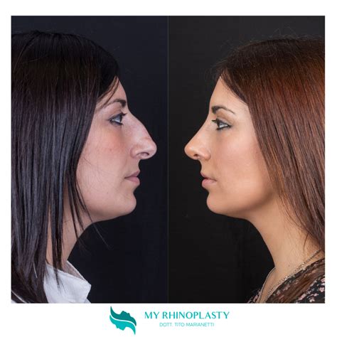 Tipi Di Naso Scopri Il Tuo E Come Correggerlo My Rhinoplasty