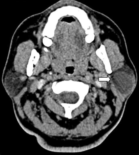 Preoperative Ct Scan Neck Axial View Cyst Like Lesion Seen In The Download Scientific Diagram