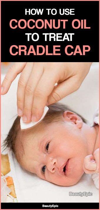 Coconut Oil For Cradle Cap Treatment How To Use Cradle Cap