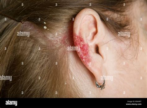 Psoriasis on ear and scalp in a woman of 60 years old Stock Photo ...