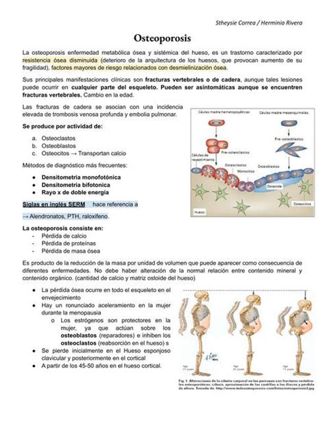 Osteoporosis Medilove Udocz