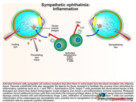 Sympathetic Ophthalmia Inflammation Inflammation Autoimmune Disease