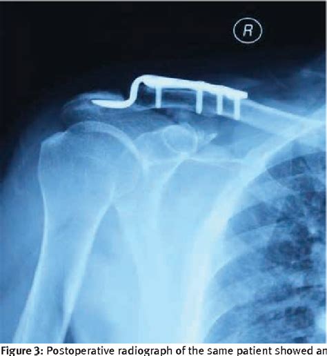 Acromioclavicular Joint Dislocations Treated With Coracoclavicular