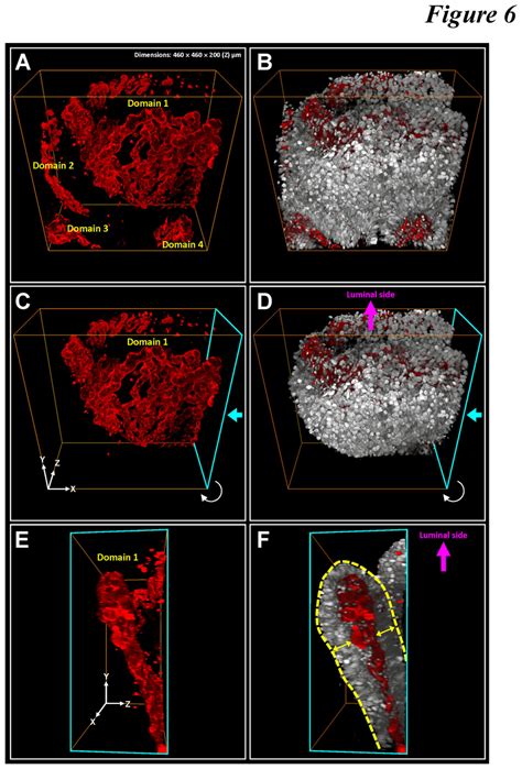 Layer Like Microvascular Network Folded In Space In Adenocarcinoma A