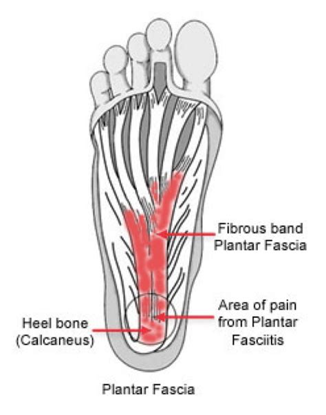 How To Treat Plantar Fasciitis Pogo Physio Gold Coast