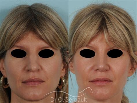 Rhinoplastie Avant Apr S Photos Et Exemples De Nez Refaits