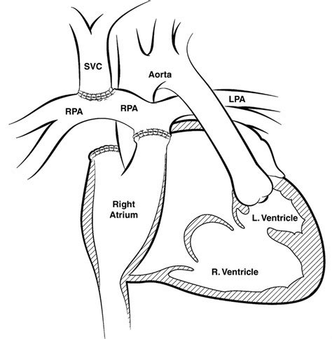 Fontan Procedure Uses Types Recovery Complications