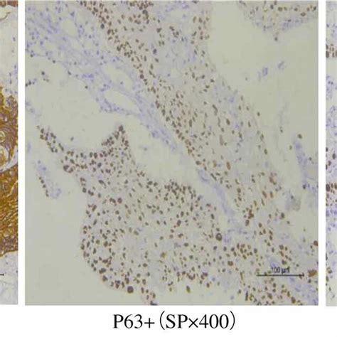 Immunostaining Pattern Of Ck5 6 P63 And P40 In Squamous Cell