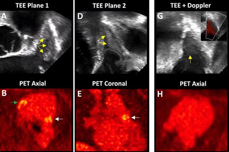 Evaluation Of Tissue Fibrin Accumulation And Perfusion In Long Covid